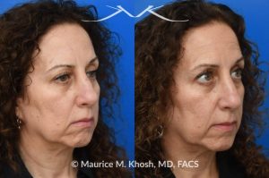 Photo of a patient before and after a procedure. Nose fracture, dorsal widening and deviaiton to the left side. - photo before and after repair.