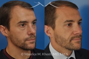 Photo of a patient before and after a procedure. Nose fracture - due to sports injury. Correction of the  deviated septum, placement of a left sided spreader graft, and right sided osteotomies to correct the displaced nasal bone