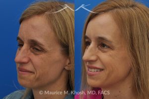 Photo of a patient before and after a procedure. Osteoma of the Left Forehead - before-and-after composite photo.