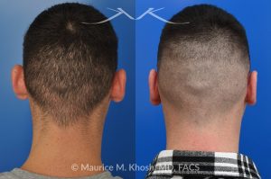 Photo of a patient before and after a procedure. Otoplasty to Correct Prominent Ears and Reduce Left Ear Size - This 26 year-old requested consultation regarding earpinnig and reducing the size of the left ear. He found both ears to be sticking out too far, and noted the left ear to be larger than the right side. Otopalsty was performed under local anesthesia in our Manhattan office. Both ears were pushed closer to the scalp. The left ear was shortened.