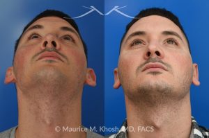 Photo of a patient before and after a procedure. Otoplasty to Correct Prominent Ears and Reduce Left Ear Size - This 26 year-old requested consultation regarding earpinnig and reducing the size of the left ear. He found both ears to be sticking out too far, and noted the left ear to be larger than the right side. Otopalsty was performed under local anesthesia in our Manhattan office. Both ears were pushed closer to the scalp. The left ear was shortened.