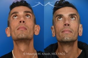 Photo of a patient before and after a procedure. Ear Pinning with Mustarde Sutures - This pleasant patient presented with interest in otoplasty in Manhattan to address prominent ears and reduce auricular projection. The procedure for ear pinning involved conchal setback and Mustarde sutures.