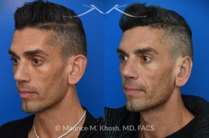 Photo of a patient before and after a procedure. Ear Pinning with Mustarde Sutures - This pleasant patient presented with interest in otoplasty in Manhattan to address prominent ears and reduce auricular projection. The procedure for ear pinning involved conchal setback and Mustarde sutures.