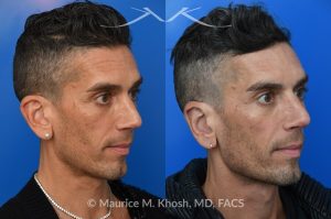Photo of a patient before and after a procedure. Ear Pinning with Mustarde Sutures - This pleasant patient presented with interest in otoplasty in Manhattan to address prominent ears and reduce auricular projection. The procedure for ear pinning involved conchal setback and Mustarde sutures.