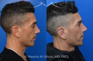 Photo of a patient before and after a procedure. Ear Pinning with Mustarde Sutures - This pleasant patient presented with interest in otoplasty in Manhattan to address prominent ears and reduce auricular projection. The procedure for ear pinning involved conchal setback and Mustarde sutures.