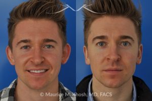 Photo of a patient before and after a procedure. Otoplasty - Ear pinning to push back excessively projected ears and flatten ears.