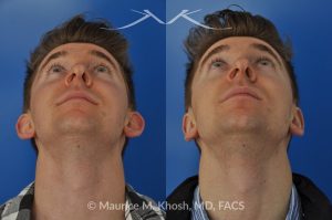 Photo of a patient before and after a procedure. Otoplasty - Ear pinning to push back excessively projected ears and flatten ears.