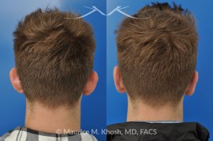 Photo of a patient before and after a procedure. Otoplasty - Ear pinning to push back excessively projected ears and flatten ears.