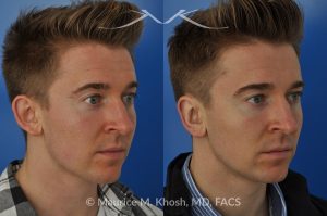 Photo of a patient before and after a procedure. Otoplasty - Ear pinning to push back excessively projected ears and flatten ears.