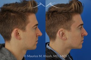 Photo of a patient before and after a procedure. Otoplasty - Ear pinning to push back excessively projected ears and flatten ears.
