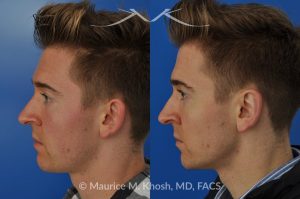 Photo of a patient before and after a procedure. Otoplasty - Ear pinning to push back excessively projected ears and flatten ears.