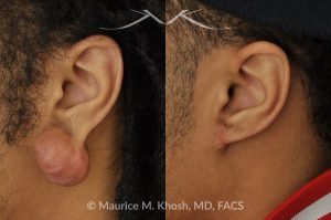 Photo of a patient before and after a procedure. Reconstruction of the ear after removing a large keloid from the earlobe - before and after treatment results.