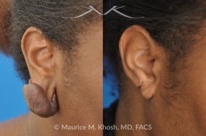 Photo of a patient before and after a procedure. Recurrent Earlobe Keloid Successfully Treated - Keloid from this earlobe had been previously excised twice. On each occasion, the keloid recurred within a few months. The keloid was surgically removed and post excision Kenalog injections have helped to prevent keloid recurrence. The picture shows one year post operative results.