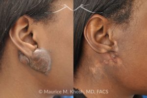 Photo of a patient before and after a procedure. Recurrent Earlobe Keloid Treated with Surgery & Radiation - This 24 year old had a keloid of the right which had been excised three times in the past. Each time the keloid recurred and became larger. She was treated with surgical excision followed by radiation therapy. The pictures depict a one year post operative result.