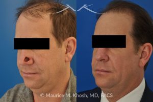 Photo of a patient before and after a procedure. Repair of Moh's defect of the lower nose with local skin flap - before and after photos.