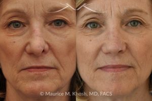 Photo of a patient before and after a procedure. Secondary repair of nostril retraction after attempted Mohs repair of the lower nose - This lovely 60 year-old had undergone repair of Mohs cancer removal from the left lower nose, by another surgeon. Unfortunately, this resulted in severe retraction of the left nostril and an unacceptable nasal deformity. 
Rhinoplasty to address nostril retraction was performed in Manhattan. Cartilage graft to the left nostril and composite graft (combination of skin and cartilage graft) to the inside edge of the nostril, helped to restore normality to the nose. The post op pictures are 6 months following her rhinoplasty.