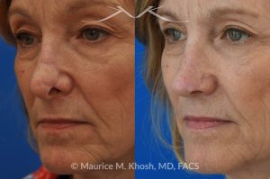 Photo of a patient before and after a procedure. Secondary repair of nostril retraction after attempted Mohs repair of the lower nose - This lovely 60 year-old had undergone repair of Mohs cancer removal from the left lower nose, by another surgeon. Unfortunately, this resulted in severe retraction of the left nostril and an unacceptable nasal deformity. 
Rhinoplasty to address nostril retraction was performed in Manhattan. Cartilage graft to the left nostril and composite graft (combination of skin and cartilage graft) to the inside edge of the nostril, helped to restore normality to the nose. The post op pictures are 6 months following her rhinoplasty.