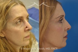 Photo of a patient before and after a procedure. Skin cancer defect of the nose, after Moh's surgery, reapired with bilobed flap - This lovely patient had undergone Moh’s surgery to remove a skin cancer from the lower part of her nose. The nose defect was repaired with a bi-lobed skin flap, from the upper nose. The right side photo demonstrates the results three years after her reconstructive surgery.
