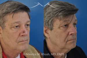 Photo of a patient before and after a procedure. Patient with basal cell skin cancer removed from the right lower nose - The nose defect was repaired with a skin graft obtained from the skin in front of the ear.