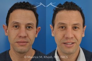 Photo of a patient before and after a procedure. Ear Pinning (Otoplasty) - for over projected large ears.