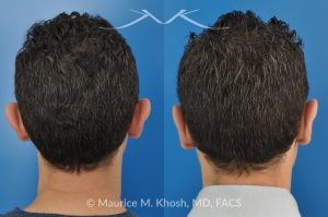 Photo of a patient before and after a procedure. Ear Pinning (Otoplasty) - for over projected large ears.