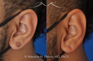 Photo of a patient before and after a procedure. Left Earlobe Keloid Removal with Invisible Scar - This 38 year-old underwent excision of a left earlobe keloid. The post op pictures show an imperceptible scar after keloid removal.
