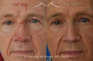 Photo of a patient before and after a procedure. Secondary repair of nasal tip defect following Mohs excision of skin cancer - This 76 year old had undergone excision of a basal cell cancer from the tip of his nose. He was dismayed at the highly visible depressed scar in his tip. Local tissue advancement flaps, followed by a series of microneedling treatments helped to restore his nasal tip to a normal appearance.