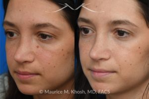 Photo of a patient before and after a procedure. Mole on the left cheek and right side of the nose - before and after removal.