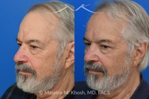 Photo of a patient before and after a procedure. Osteoma - before-and-after composite photo.