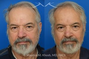 Photo of a patient before and after a procedure. Osteoma - before-and-after composite photo.