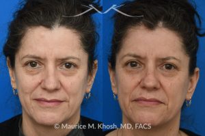 Photo of a patient before and after a procedure. Osteoma - before and after composite photo.