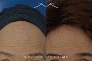 Photo of a patient before and after a procedure. Surgical Removal of Forehead Bony Hump - before-and-after composite photo.
