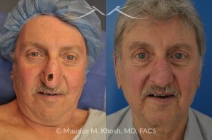 Photo of a patient before and after a procedure. Repair of Moh's defect of the lower nose after removal of basal cell cancer of skin. Bilobed flap technique - before and after photos.