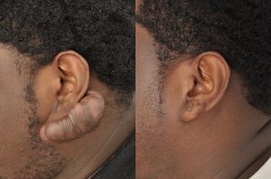 Photo of a patient before and after a procedure. Treatment of a Very Large Ear Keloid - One year post op result.