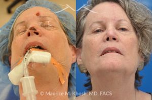Photo of a patient before and after a procedure. Mohs reconstruction of nose - before and after photos.