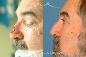 Photo of a patient before and after a procedure. Nose Mohs cancer reconstruction with forehead flap - before and after photos.