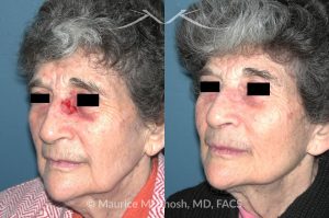 Photo of a patient before and after a procedure. Nose Mohs skin cancer repair - before and after photos.
