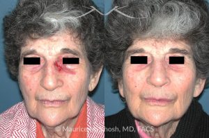 Photo of a patient before and after a procedure. Nose Mohs skin cancer repair - before and after photos.