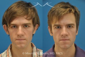 Photo of a patient before and after a procedure. Otoplasty - ear before and after correction.