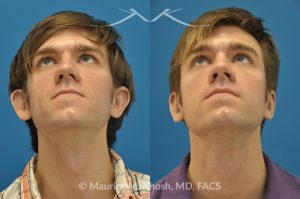Photo of a patient before and after a procedure. Otoplasty - ear before and after correction.