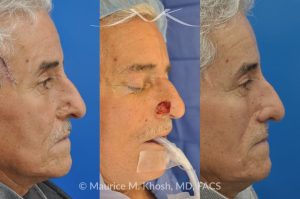Photo of a patient before and after a procedure. Mohs Surgery and Nasal Reconstruction for Basal Cell Carcinoma - This 69 year old gentleman had Basal Cell Carcinoma of the skin of the right nasal lobule (shown on the left side). The skin cancer was removed via the Mohs technique resulting in near total loss of the right nasal ala (central picture). The nose was reconstructed in a two stage operation utilizing a right nasolabial flap and cartilage graft. The final results are shown on the right side of the picture.