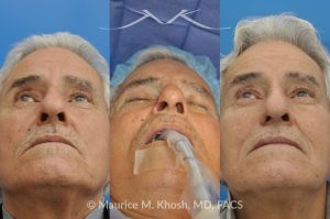 Photo of a patient before and after a procedure. Mohs Surgery and Nasal Reconstruction for Basal Cell Carcinoma - This 69 year old gentleman had Basal Cell Carcinoma of the skin of the right nasal lobule (shown on the left side). The skin cancer was removed via the Mohs technique resulting in near total loss of the right nasal ala (central picture). The nose was reconstructed in a two stage operation utilizing a right nasolabial flap and cartilage graft. The final results are shown on the right side of the picture.