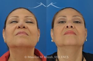 Photo of a patient before and after a procedure. Removal of skin cancer in the tip of the nose with repair - before and after photos.