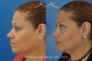Photo of a patient before and after a procedure. Removal of skin cancer in the tip of the nose with repair - before and after photos.