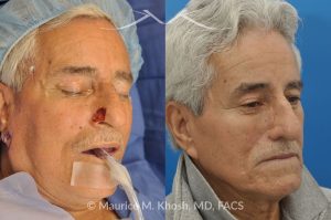 Photo of a patient before and after a procedure. Mohs Surgery and Nasal Reconstruction for Basal Cell Carcinoma - This 69 year old gentleman had Basal Cell Carcinoma of the skin of the right nasal lobule (shown on the left side). The skin cancer was removed via the Mohs technique resulting in near total loss of the right nasal ala (central picture). The nose was reconstructed in a two stage operation utilizing a right nasolabial flap and cartilage graft. The final results are shown on the right side of the picture.