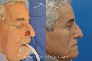 Photo of a patient before and after a procedure. Mohs Surgery and Nasal Reconstruction for Basal Cell Carcinoma - This 69 year old gentleman had Basal Cell Carcinoma of the skin of the right nasal lobule (shown on the left side). The skin cancer was removed via the Mohs technique resulting in near total loss of the right nasal ala (central picture). The nose was reconstructed in a two stage operation utilizing a right nasolabial flap and cartilage graft. The final results are shown on the right side of the picture.