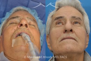 Photo of a patient before and after a procedure. Mohs Surgery and Nasal Reconstruction for Basal Cell Carcinoma - This 69 year old gentleman had Basal Cell Carcinoma of the skin of the right nasal lobule (shown on the left side). The skin cancer was removed via the Mohs technique resulting in near total loss of the right nasal ala (central picture). The nose was reconstructed in a two stage operation utilizing a right nasolabial flap and cartilage graft. The final results are shown on the right side of the picture.
