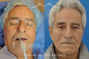 Photo of a patient before and after a procedure. Mohs Surgery and Nasal Reconstruction for Basal Cell Carcinoma - This 69 year old gentleman had Basal Cell Carcinoma of the skin of the right nasal lobule (shown on the left side). The skin cancer was removed via the Mohs technique resulting in near total loss of the right nasal ala (central picture). The nose was reconstructed in a two stage operation utilizing a right nasolabial flap and cartilage graft. The final results are shown on the right side of the picture.