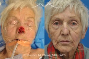 Photo of a patient before and after a procedure. Nose Mohs skin cancer repair, utilizing forehead flap and ear cartilage graft - before and after photos.