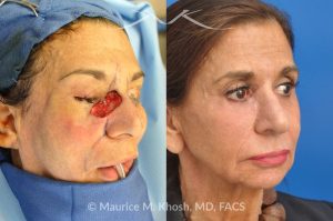 Photo of a patient before and after a procedure. Repair of squamous cell skin cancer of nose and lower eyelid with forehead flap - before and after photos.